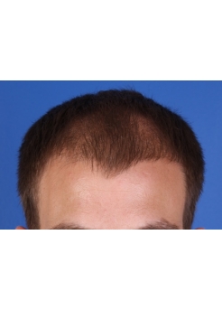 Before Hair Transplant&nbsp;Front
